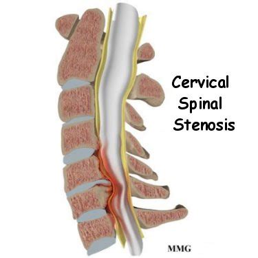 Cervical Canal