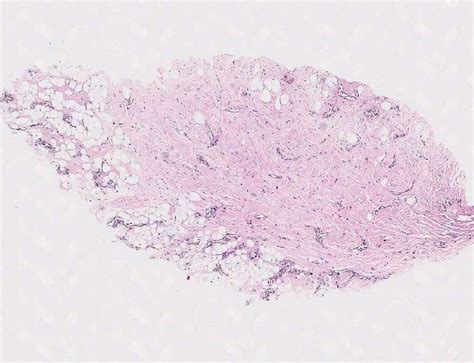 Fibroadenoma (core biopsy) – BosnianPathology