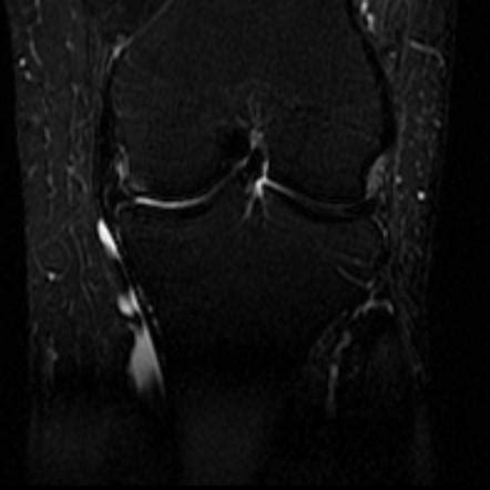 Pes anserinus bursitis | Image | Radiopaedia.org