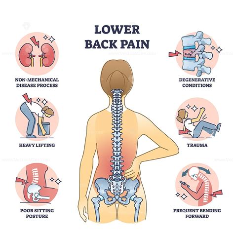 Lower back pain and painful body backbone skeleton causes outline diagram - VectorMine