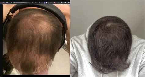 Finasteride 8 months progress ! : r/tressless