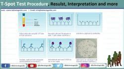 T-Spot Test Procedure, Results And Interpretation | Lab Tests Guide