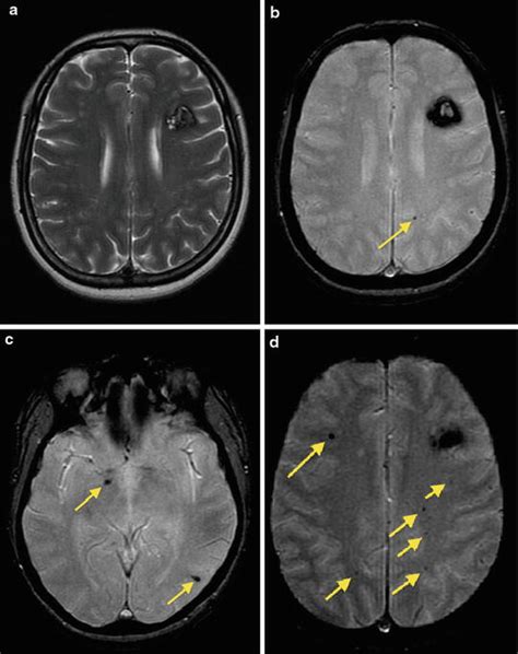 Miscellaneous Vascular Malformations (Cavernous Malformations, Developmental Venous Anomaly ...