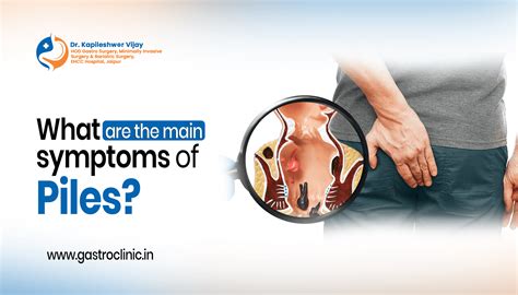 What are the main symptoms of Piles - 8 Main symptoms | Gastro Clinic