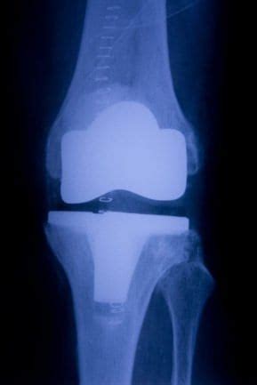 DePuy Synthes Attune® Knee Replacement Lawsuit | DSS LawDavis ...