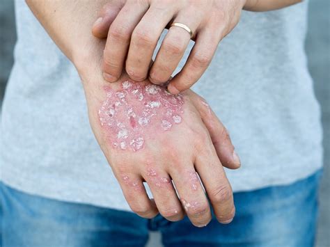 Psoriasis - Symptoms, Causes, Treatment and Photos