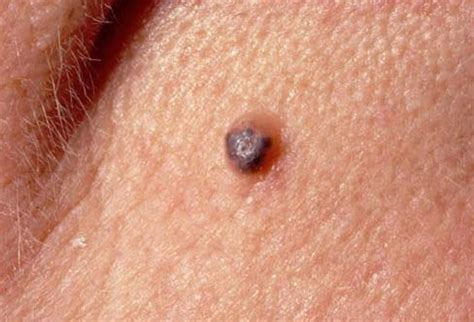 Nonmelanoma Skin Cancers You Need to Know