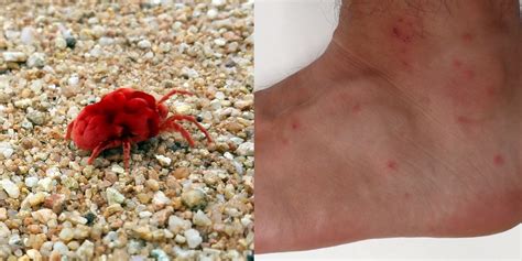 Chiggers Bites Look Like