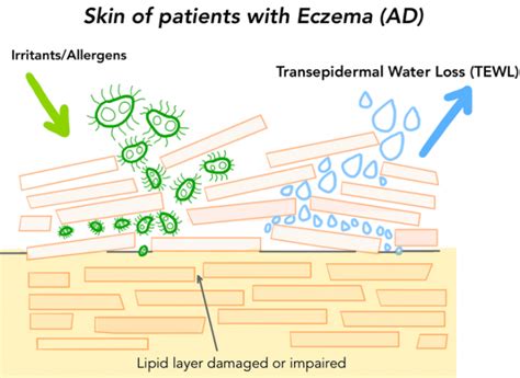 Eczema Management with Best Ceramide Moisturisers