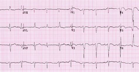 Left Ventricular Aneurysm Ecg