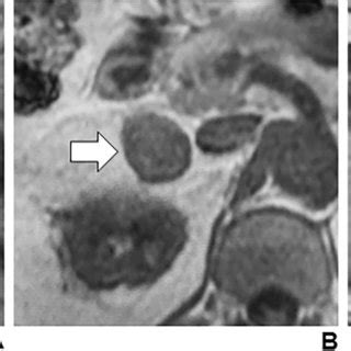 48-year-old female with right lipid-poor adrenal adenoma. A Axial T2W... | Download Scientific ...