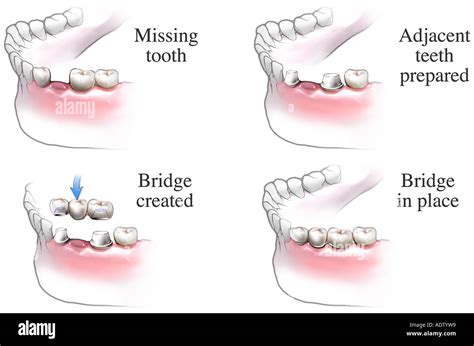 Dental Bridge Procedure