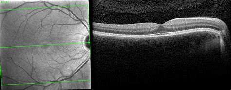 Macular Edema Remedies: Review of Treatment Options