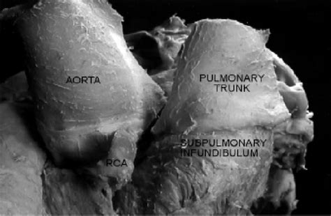 The anatomy of the tendon of infundibulum. | Semantic Scholar