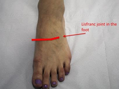 Lisfranc Fracture Surgery | Private Surgeon London | London Foot and Ankle