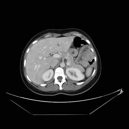 Insulinoma | Radiology Reference Article | Radiopaedia.org