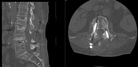 Pedicle Subtraction Osteotomy for Treatment of Sagittal Plane Deformity - cns.org