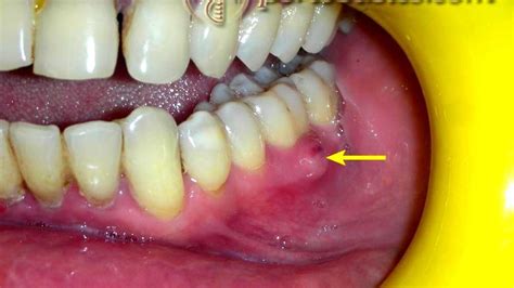 Periodontal abscess