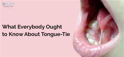 Tongue-Tie | Ankyloglossia