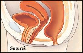 Pelvic Organ Prolapse: Surgery for Cystocele | Saint Luke's Health System