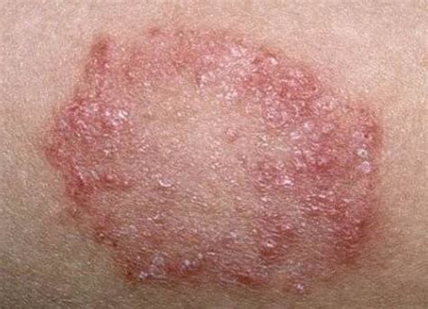Skin disease or Eczema- Eczema—Also known as atopic dermatitis, this is a long-term skin disease ...