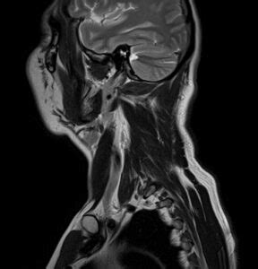 MRI Soft tissue neck sagittal T2 images