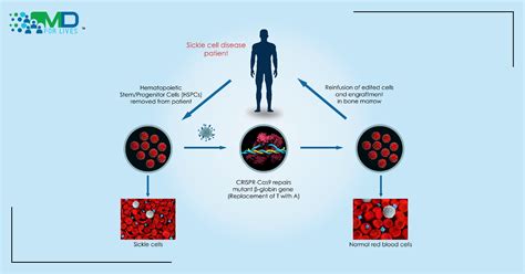 FDA Approves First Trial of CRISPR for Sickle Cell Disease