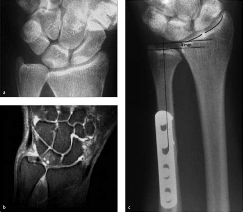 27 Treatment of Lunotriquetral Injuries | Musculoskeletal Key