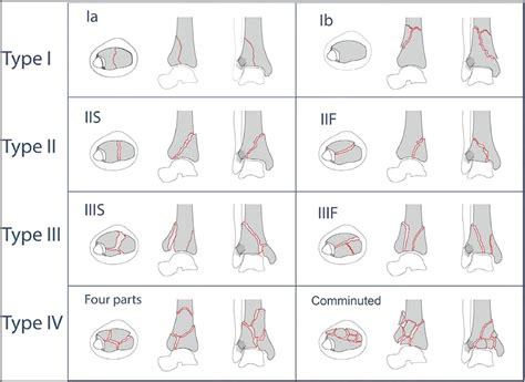 What Is the Most Reliable Classification System to Assess Tibial Pilon Fractures? - The Journal ...