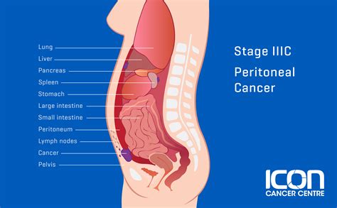 Peritoneal Cancer Types, Signs, Symptoms & Stages