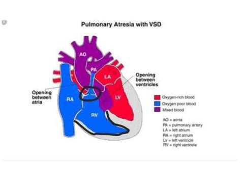 Pulmonary Atresia - YouTube