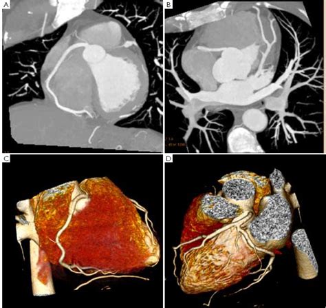 Cardiac CT imaging in coronary artery disease: Current status and future directions - Sun ...