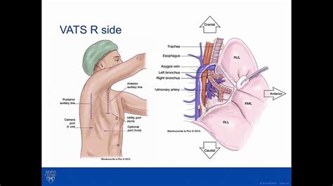 VATS Right Middle Lobe Lobectomy in the Setting of Oligometastatic Lung ...