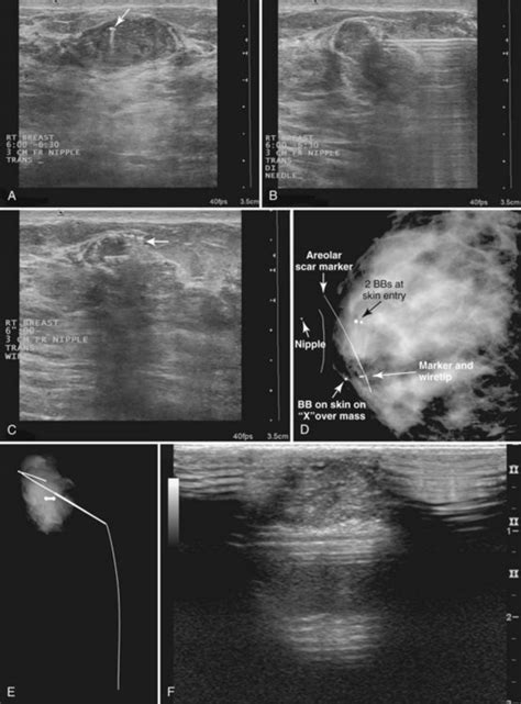 Mammographic and Ultrasound-Guided Breast Biopsy Procedures | Radiology Key