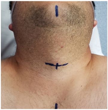 Laryngeal framework surgery - MedCrave online