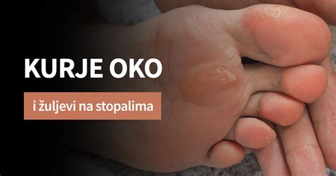 Kurje oko i žuljevi na stopalima - Neprijatnosti koje se mogu sanirati