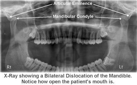 Dislocated Jaw X Ray