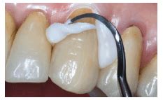 Meron Plus QM from VOCO - Decisions in Dentistry