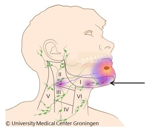 Cancers | Free Full-Text | Elective Neck Dissection or Sentinel Lymph Node Biopsy in Early Stage ...