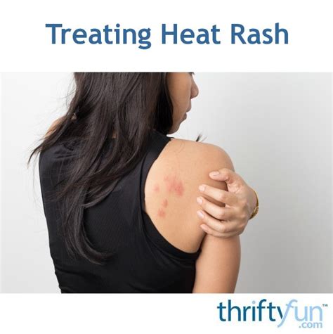 Treating Heat Rash | ThriftyFun