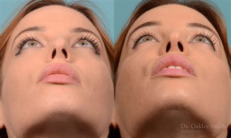 Rhinoplasty Nose Surgeon Ontario Dr Smith