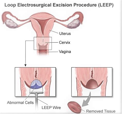 LEEP Procedure - Need, Preparation, Procedure, Cost, Recovery Process