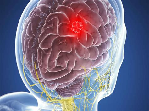 Meningioma: 10 Meningioma Symptoms