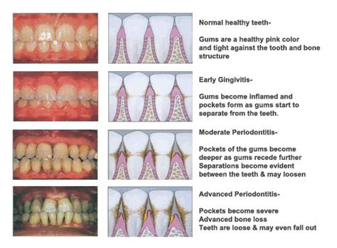 What are gingivitis and gum disease? | Dr. Nechupadam Dental Clinic