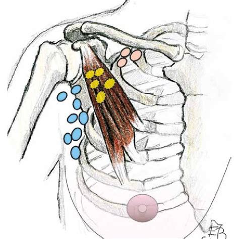 Axillary Lymph Nodes Cancer