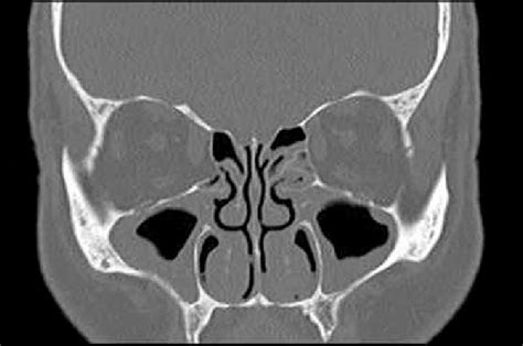 Maxillary and ethmoidal sinusitis are seen in the coronal section of... | Download Scientific ...