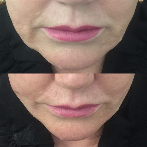 Non-surgical Jowl Lift | Thread Lift, HIFU, Injectables & Fillers for Jowl