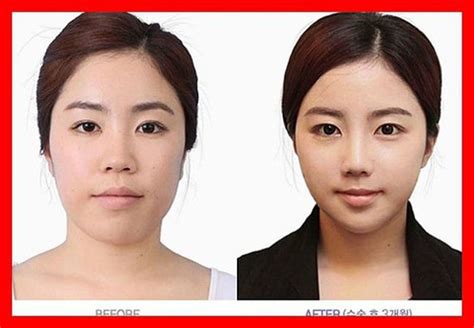 Antes e depois da cirurgia plástica coreana 2 (61 fotos) - MDig