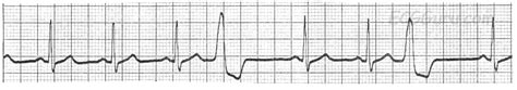 ECG Basics: Normal Sinus Rhythm With Premature Ventricular Contractions ...