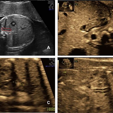 Pearson's Correlation Between the Fetal Adrenal Gland Ultrasound... | Download Scientific Diagram